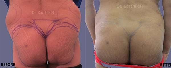 butt fatfill before and after photo by chennai plastic surgery in india