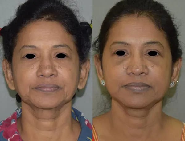 facelift before and after photo by chennai plastic surgery in india