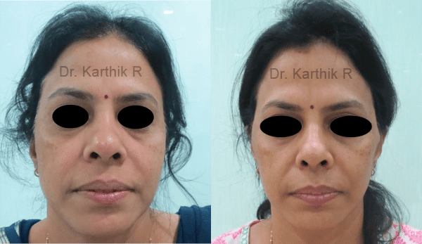 non surgical face lift before and after photo by chennai plastic surgery in india