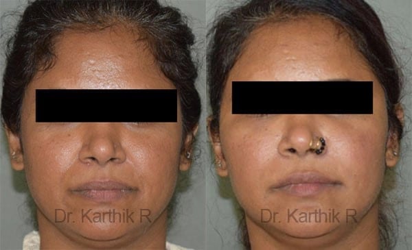 fat graft fat fill fat transfer before and after photo by chennai plastic surgery in india