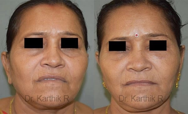 fat graft fat fill fat transfer before and after photo by chennai plastic surgery in india