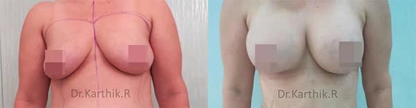breast implants before and after photo by chennai plastic surgery in india