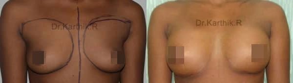 breast implants before and after photo by chennai plastic surgery in india