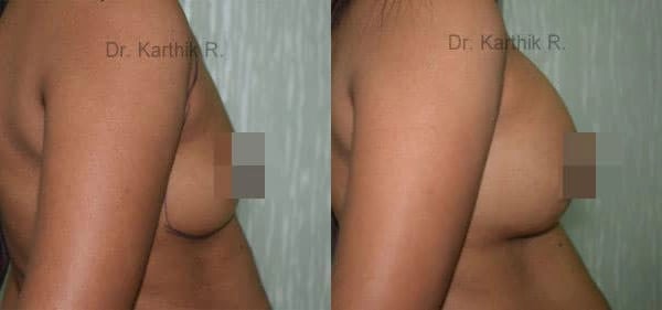 breast implants before and after photo by chennai plastic surgery in india