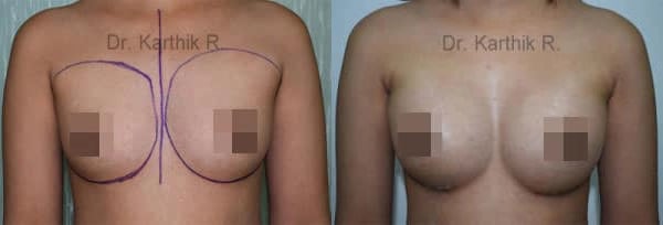 breast implants before and after photo by chennai plastic surgery in india