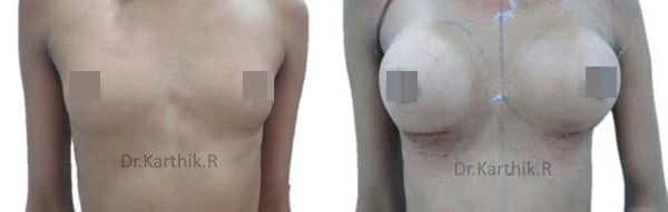 breast implants before and after photo by chennai plastic surgery in india