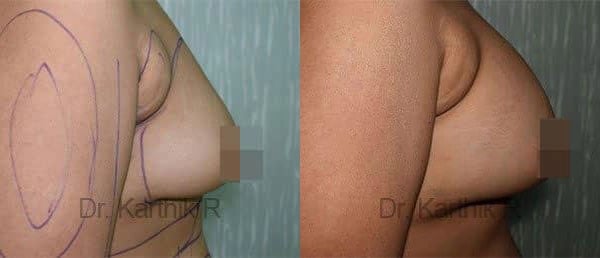 breast fat fill before and after photo by chennai plastic surgery in india