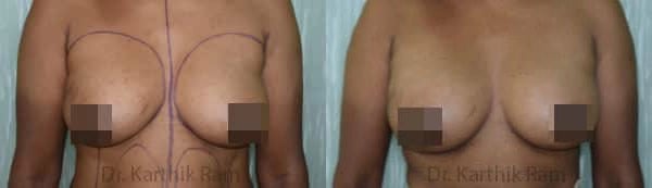breast fat fill before and after photo by chennai plastic surgery in india
