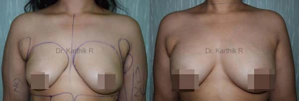 breast fat fill before and after photo by chennai plastic surgery in india