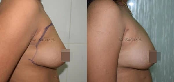 breast fat fill before and after photo by chennai plastic surgery in india