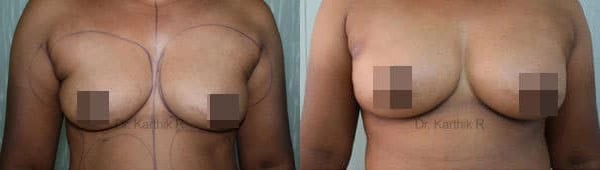 breast fat fill before and after photo by chennai plastic surgery in india