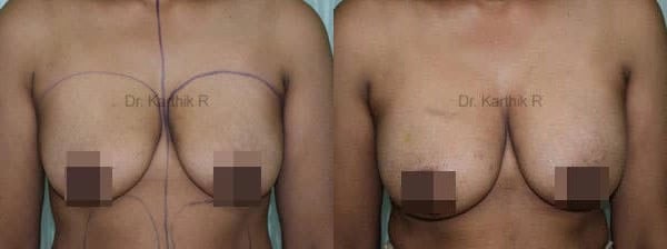 breast fat fill before and after photo by chennai plastic surgery in india