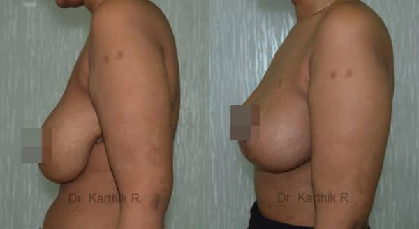 breast reduction breast lift before and after photo by chennai plastic surgery in india