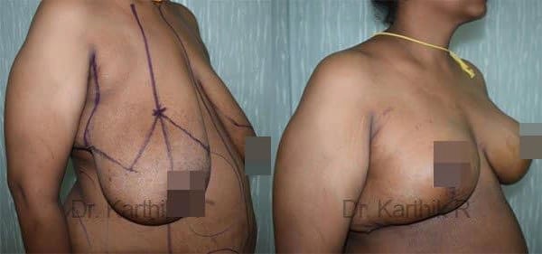 breast reduction breast lift before and after photo by chennai plastic surgery in india