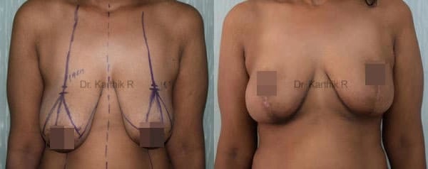 breast reduction breast lift before and after photo by chennai plastic surgery in india