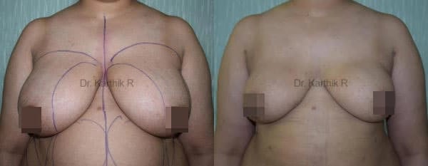 breast reduction breast lift before and after photo by chennai plastic surgery in india