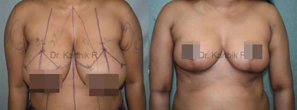 breast reduction breast lift before and after photo by chennai plastic surgery in india