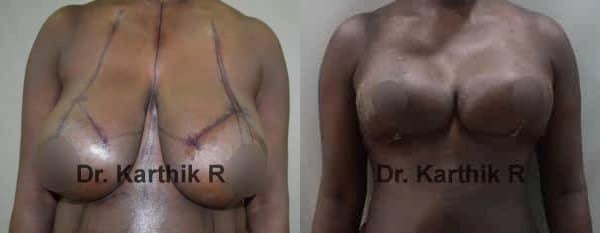 breast reduction breast lift before and after photo by chennai plastic surgery in india