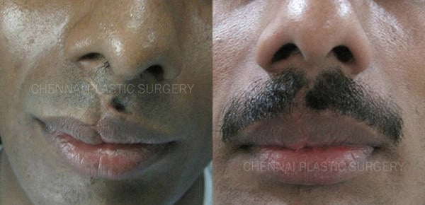 scar management before and after photo by chennai plastic surgery in india