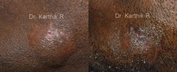 scar revision before and after photo by chennai plastic surgery in india
