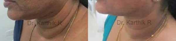 exilis before and after photo by chennai plastic surgery in india