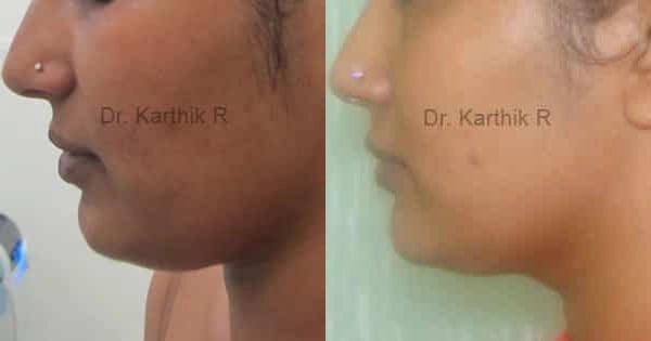 exilis before and after photo by chennai plastic surgery in india