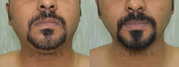 exilis before and after photo by chennai plastic surgery in india