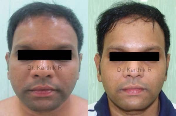 exilis before and after photo by chennai plastic surgery in india