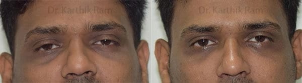 dermal fillers before and after photo by chennai plastic surgery in india