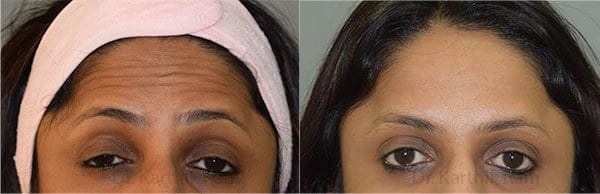 botox before and after photo by chennai plastic surgery in india