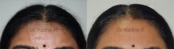 botox before and after photo by chennai plastic surgery in india