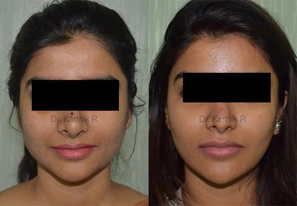 botox before and after photo by chennai plastic surgery in india