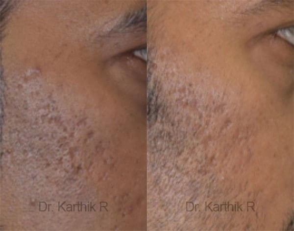 chemical peels microdermabrasion before and after photo by chennai plastic surgery in india