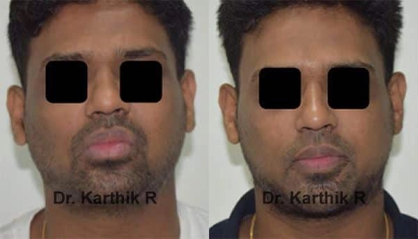 chemical peels microdermabrasion before and after photo by chennai plastic surgery in india