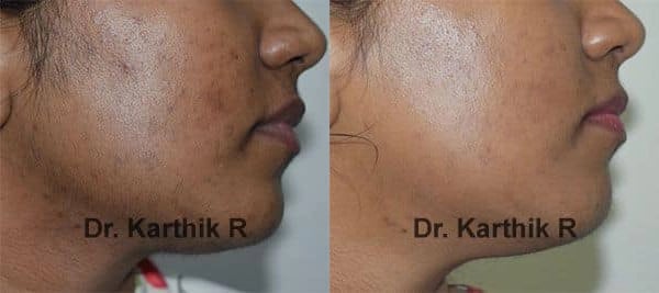 laser hair reduction before and after photo by chennai plastic surgery in india