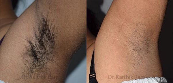 laser hair reduction before and after photo by chennai plastic surgery in india