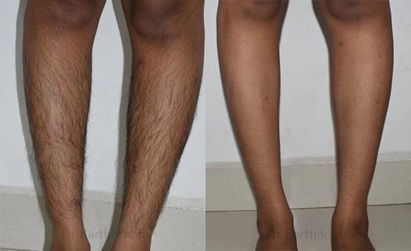 laser hair reduction before and after photo by chennai plastic surgery in india
