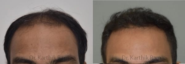 hair transplantation before and after photo by chennai plastic surgery in india