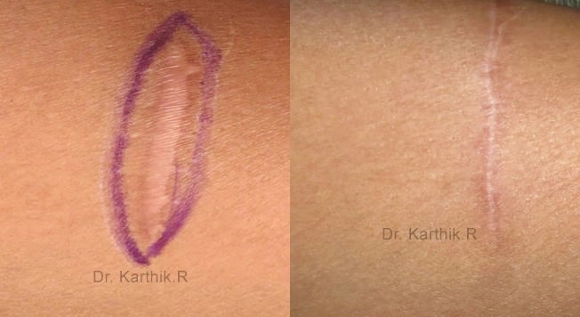 scar revision before and after photo by chennai plastic surgery in india