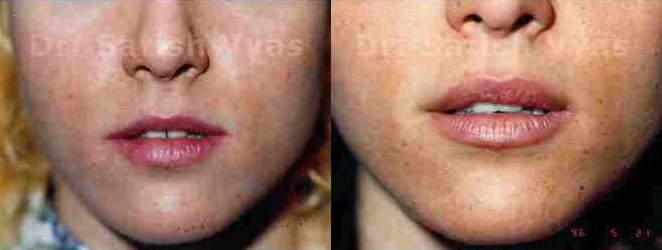 lip correction before and after photo by chennai plastic surgery in india