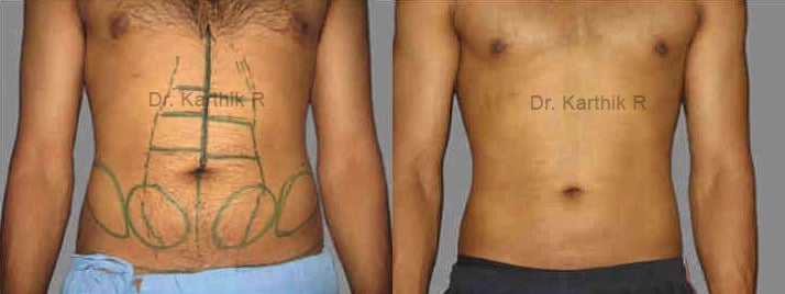 six packs abdominal etching before and after photo by chennai plastic surgery in india