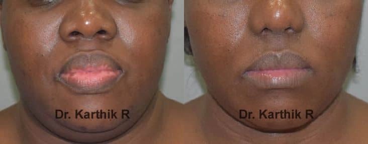 lip correction before and after photo by chennai plastic surgery in india