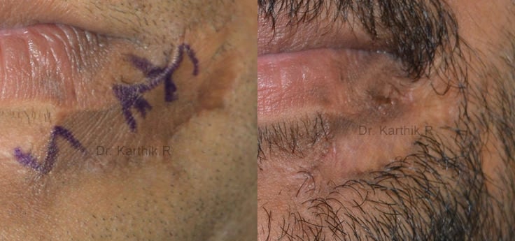 scar revision before and after photo by chennai plastic surgery in india