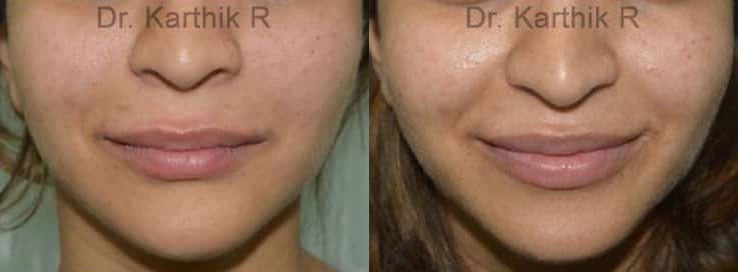 dermal fillers before and after photo by chennai plastic surgery in india