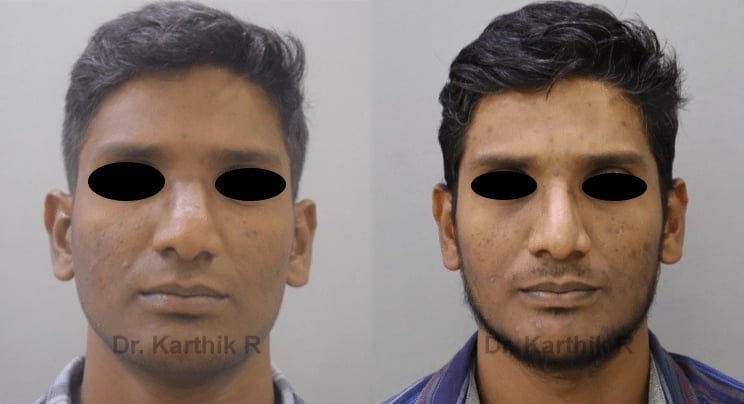 rhinoplasty before and after photo by chennai plastic surgery in india