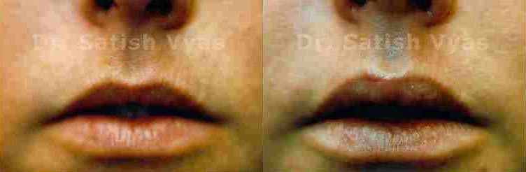 lip correction before and after photo by chennai plastic surgery in india