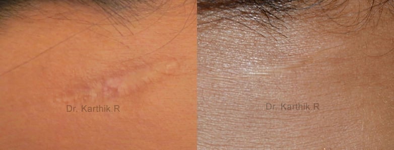 scar revision before and after photo by chennai plastic surgery in india