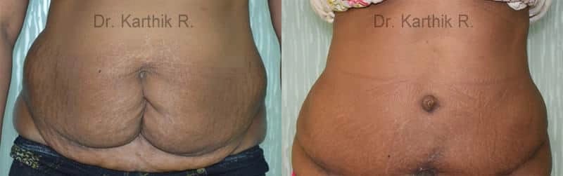 tummy tuck before and after photo by chennai plastic surgery in india