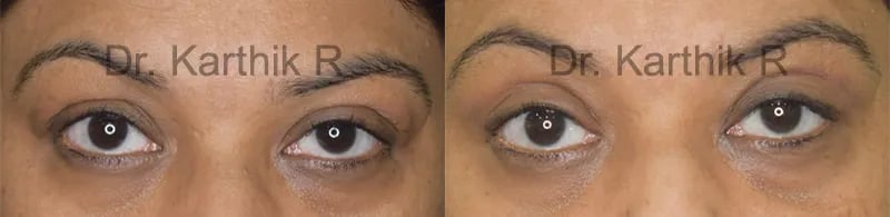 blepharoplasty before and after photo by chennai plastic surgery in india