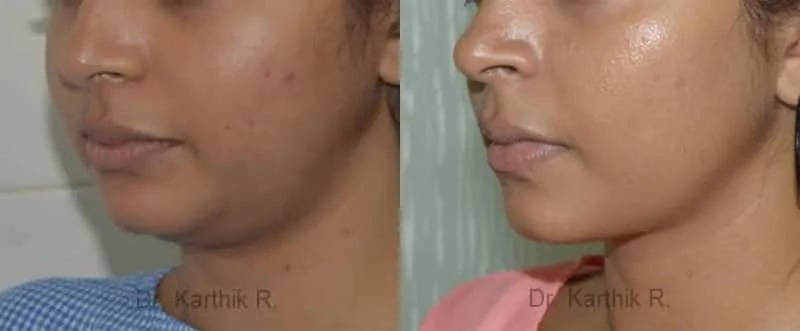 double chin liposuction before and after photo by chennai plastic surgery in india